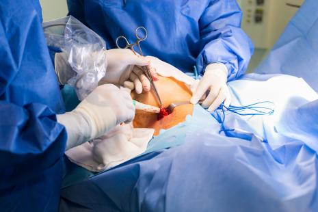  Une chirurgie décalée de huit semaines expose à une augmentation de 17 % du risque de décès
