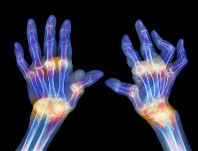 Radiographie de mains atteintes de polyarthrite rhumatoïde (PR).