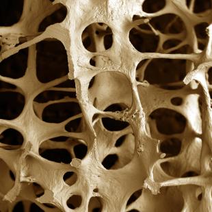 Ostéoporose : les clés pour comprendre