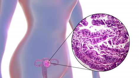 Image de synthèse et microscopie optique montrant un cancer de l'utérus.