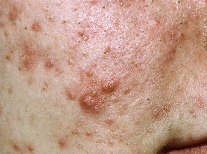 L'acné sévère est surtout un problème d'adulte | Le Quotidien du ...